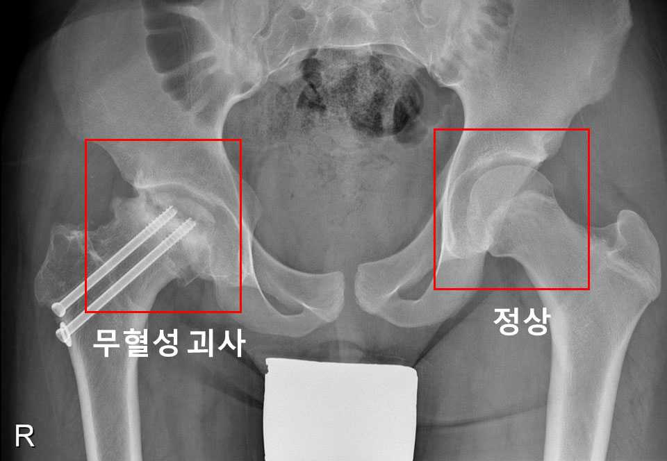 우측 고관절에 대퇴골두 골단 분리증 및 무혈성 괴사가 발생한 소아청소년 환자의 X-ray