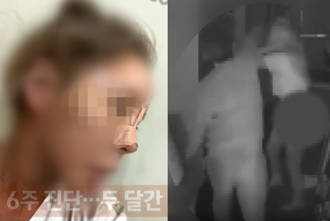 폭행을 당한 A 씨(좌)는 코뼈가 부러지는 등 전치 6주의 상해를 입었다. 매장 CCTV에는 임 씨가 A 씨를 폭행하는 모습(우)이 그대로 찍혔다.[JTBC 사건반장 캡처]