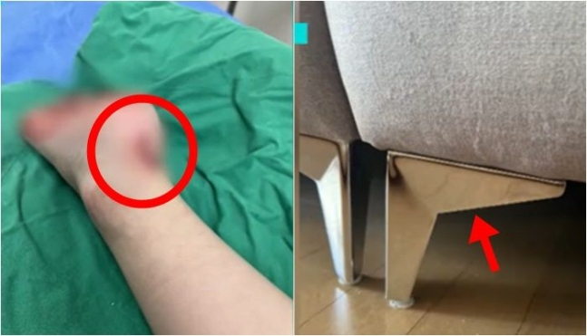 6살 A군이 소파에 앉았다가 발목 뒤 피부 6cm 정도가 찢어진 모습(왼쪽)과 금속으로 만든 소파 다리 모서리 부품. [SBS 보도화면 캡처]