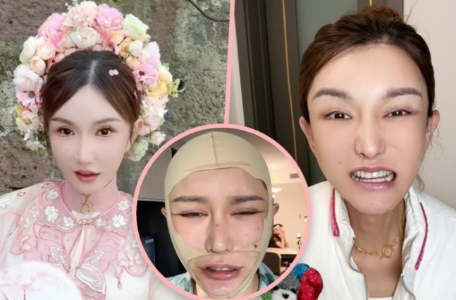 수억원을 들여 성형수술을 했지만 결국 입이 기형이 된 중국의 한 트랜스젠더 여성이 성형수술의 잠재적 위험성을 경고하고 나섰다. [사진출처 = SCMP]