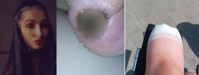 운동화로 인한 발뒤꿈치 물집이 패혈증으로 이어져 결국 다리를 잘라낸 여성[사진=영국 더선]