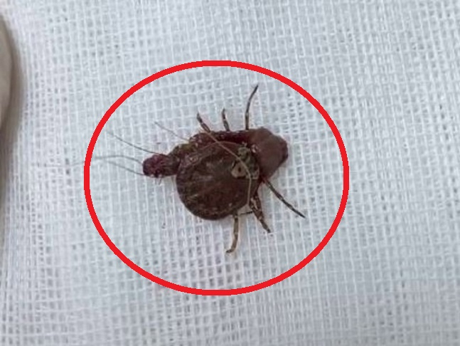 A씨 항문에서 떼어낸 진드기. [더선]