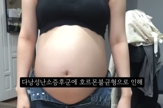 임신 36주 차에 낙태 수술을 받은 유튜버 A씨의 '낙태 브이로그' 일부. [유튜브 영상 캡처]