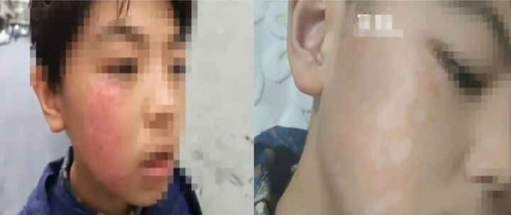 5일(현지시간) 홍콩 사우스차이나모닝포스트(SCMP)에 따르면 중국 남부 원난성에 사는 학부모는 초등학교에 다니고 있는 11세 아들 리우의 얼굴이 심하게 부어오르는 것을 보고 병원을 찾았다. [웨이보 갈무리]