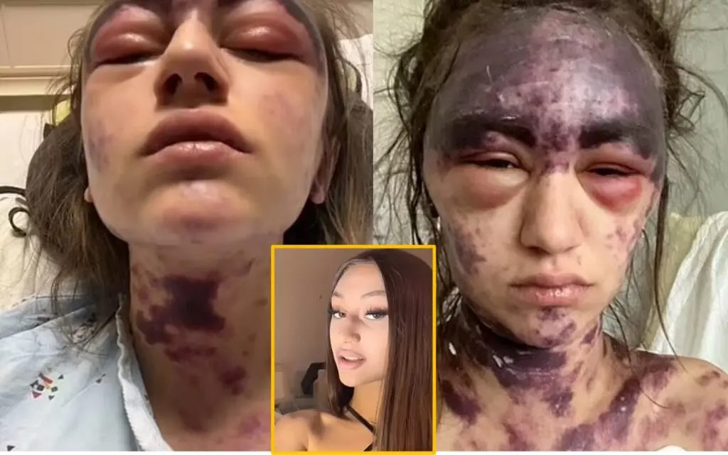 희귀 면역질환을 앓고 있는 한 20대 여성이 치료를 위해 병원을 갔다가 백신 3가지를 한꺼번에 맞고 끔찍한 부작용에 시달리고 있다. [데일리메일]