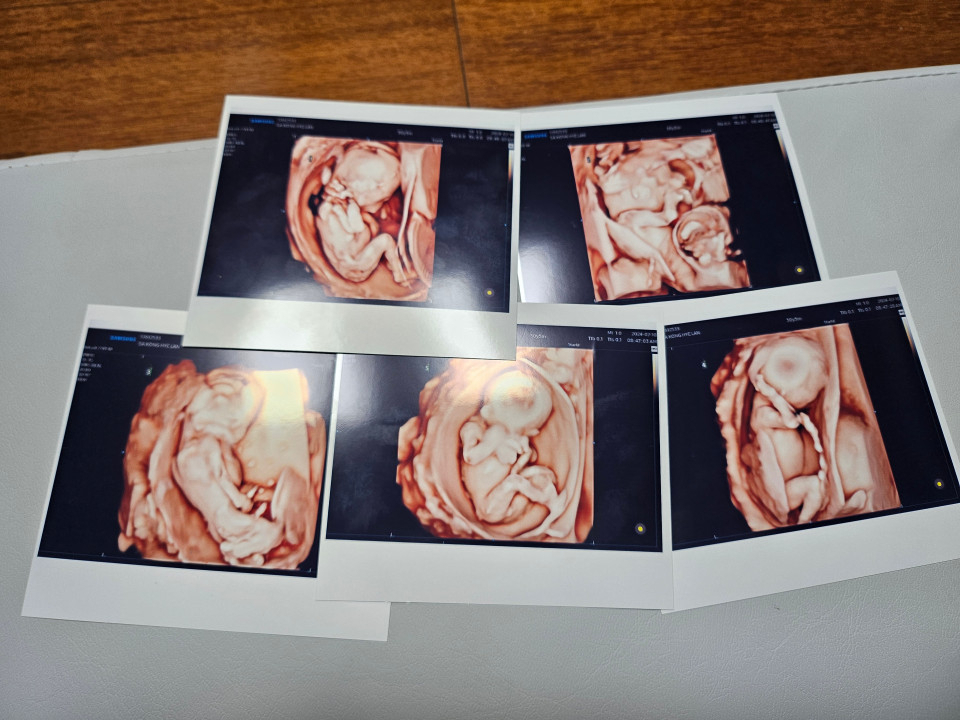 서울성모병원은 20일 낮 남자아이 3명과 여자아이 2명의 '오둥이'가 건강하게 태어났다고 밝혔다. 사진은 오둥이의 초음파 사진. 연합뉴스