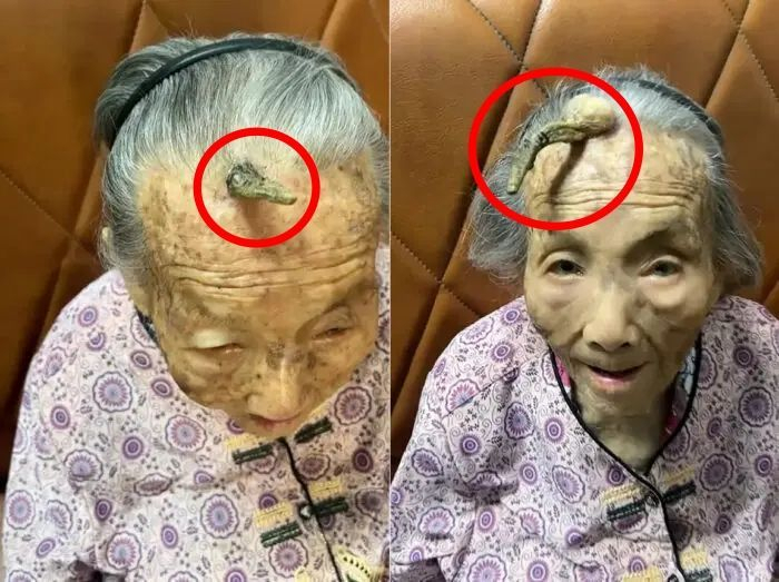 107세 중국 할머니 첸의 이마에 10㎝ 가량의 뿔이 돋아난 모습. [뉴욕포스트 갈무리]