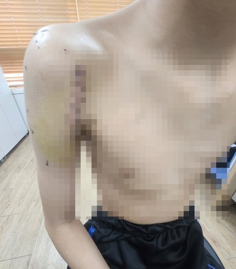 수술 직후 A군의 어깨 상태. [연합뉴스]