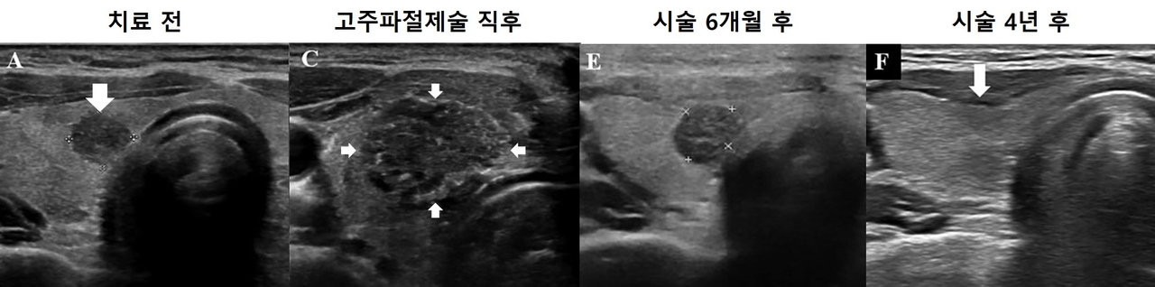 고주파절제술을 이용한 미세갑상선유두암 치료 과정. 시술 직후 괴사된 종양과 주변부가 넓게 보이지만 시간이 지나면 완전히 소멸됨.