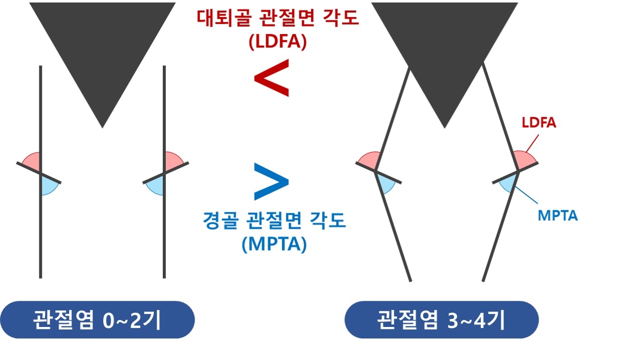 관절염 심각도별 선천적인 무릎 변수 차이