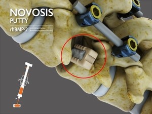 CGBio secures FDA nod for Novosis Putty clinical trial