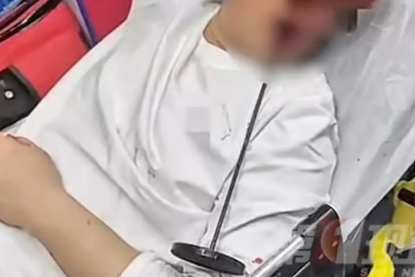중국에서 한 남성이 술에 취해 넘어졌다가 쇠막대가 머리에 꽂히는 사고를 당했다. [SCMP]