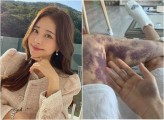 [단독] 아옳이 전신피멍 13억 소송 병원에 이겼다 “허위사실 적시 아냐” [세상&]