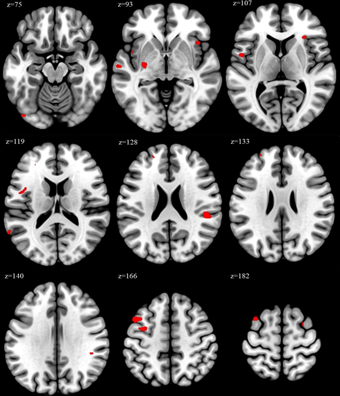 Red-marked regions in these MRI slices show brain areas where volume was significantly greater in individuals working 52 or more hours per week, according to voxel-based morphometry, a technique used to detect structural brain changes. (Image from Jang W, Kim S, Kim Y, et al. (2025). Overwork and changes in brain structure: a pilot study. Published in Occupational and Environmental Medicine. doi: 10.1136/oemed-2025-110057.)