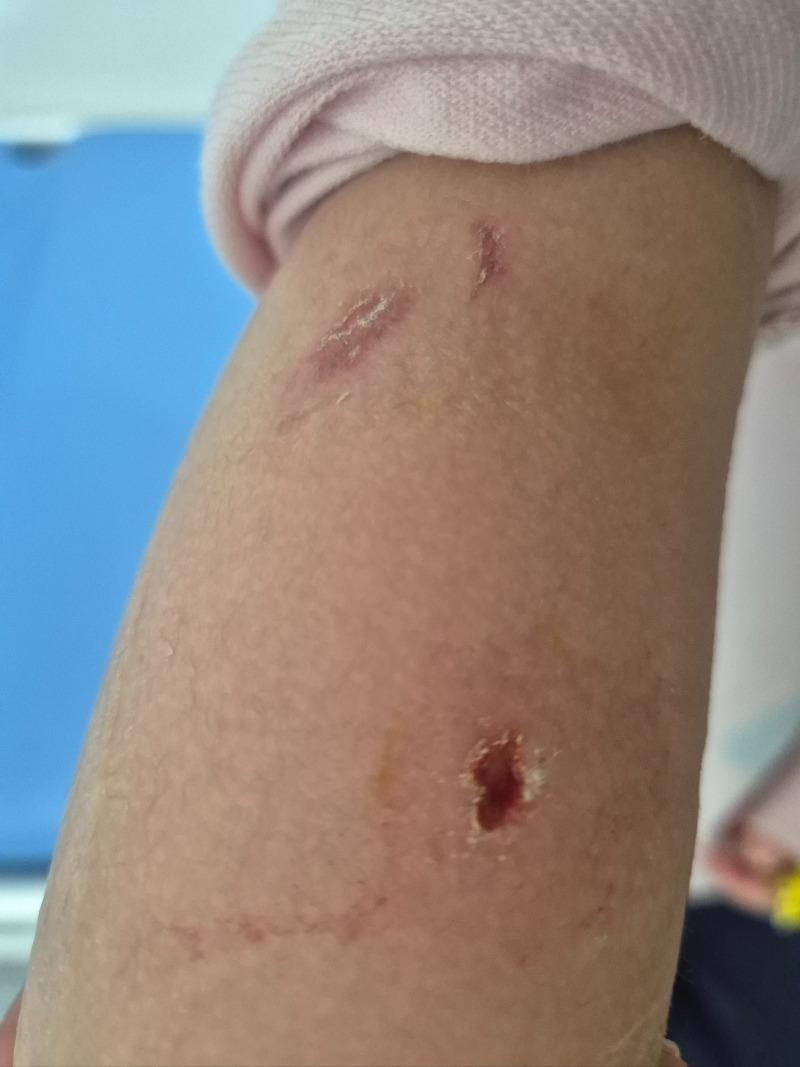 지난달 17일 전북 부안의 한 카페 앞에서 7살 여아가 대형견에 팔을 물리는 사고가 발생토토사이트 메인 디자인. [온라인 커뮤니티 ‘보배드림’ 캡처]