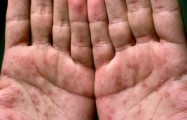 “국가 비상사태” 성관계 활발한 젊은층서 HIV 감염 500% 폭증한 ‘이 나라’