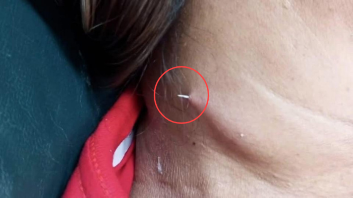 태국에서 40대 여성이 식사 중에 삼킨 생선마스터 토토사이트가 목을 관통해 피부 밖으로 돌출됐다. [방콕포스트]