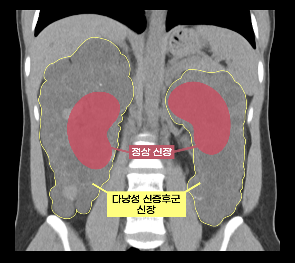 실제 다낭성 신증후군 환자의 원탑토토과 정상 원탑토토 비교(수많은 낭종으로 울퉁불퉁하고 크기도 비대해진 상태