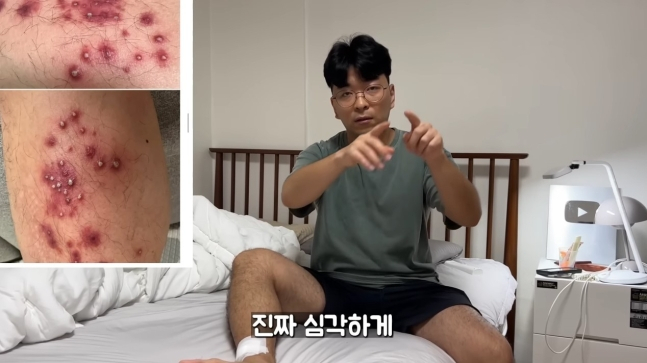 캄보디아 여행에서 저렴한 발 토토사이트 필드원를 받은 후 다리가 염증으로 뒤덮였다는 유튜버.  [유튜브 갈무리]