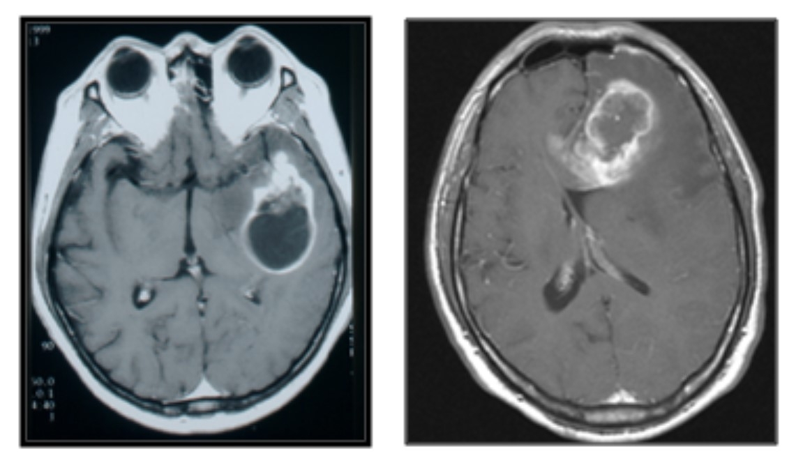 악성 뇌토토사이트 케이 벳(교모세포종) MRI