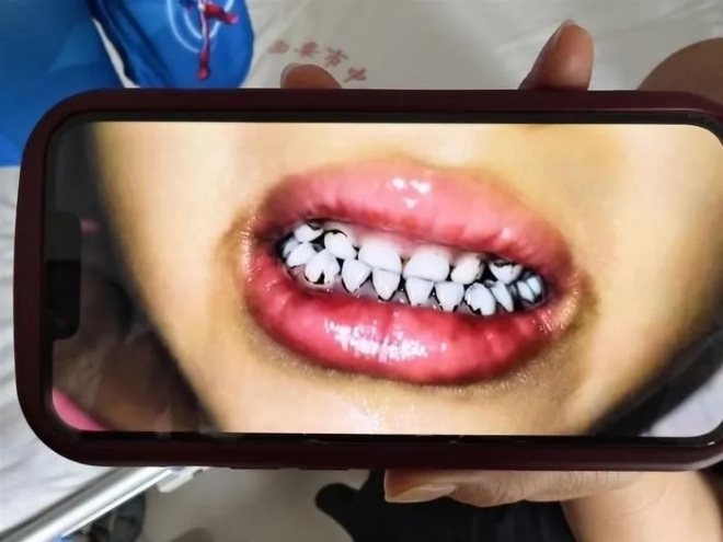 중국서 납중독 의심으로 치아 일부가 검게 변한 쪽티비 스포츠토토생. [중국 매체 지무뉴스]