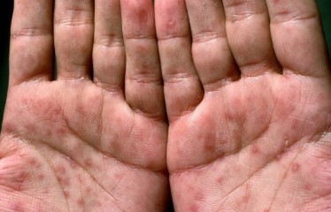 “손바닥이 왜 이래?” 알고보니 최악의 ‘죽음의 병’…한국 치료제에 전 세계 ‘들썩’