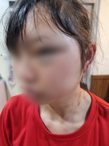 A Vietnamese migrant worker assaulted by her Korean supervisor in his 40s at a food company in Gyeonggi Province in May. (Yonhap)