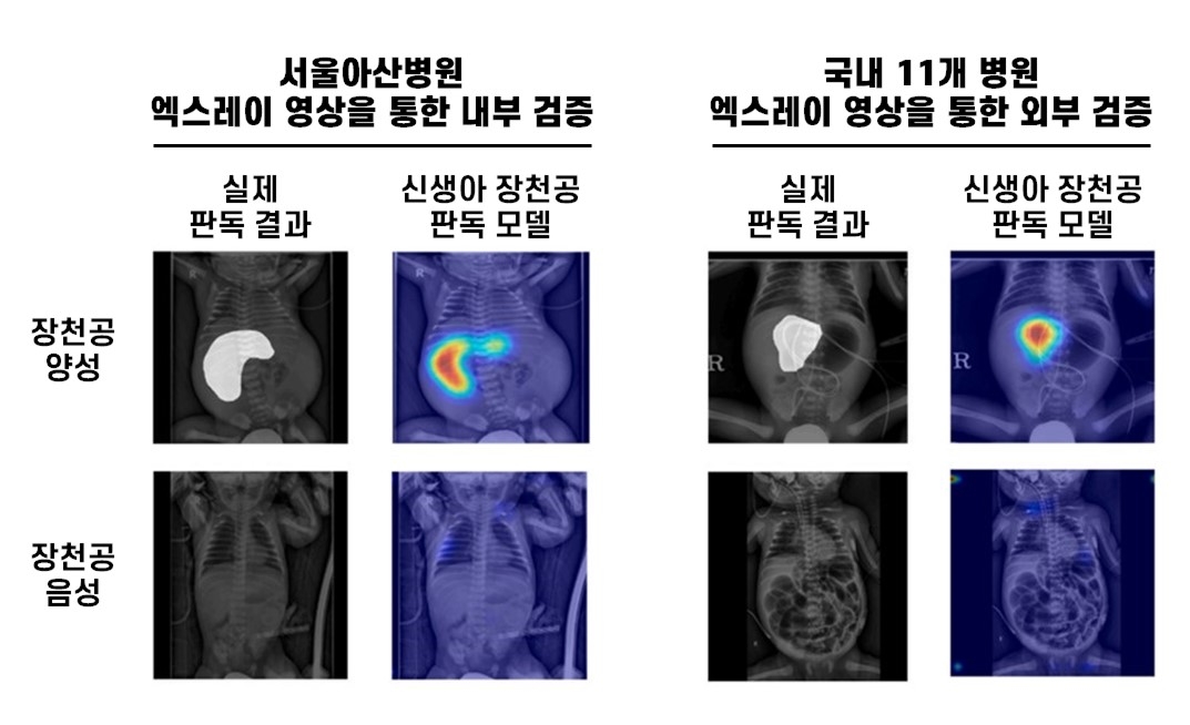 유탑 토토사이트 장천공 인공지능 판독 모델은 복강 내 공기가 차 있는 영역 등을 정확히 식별하며 장천공 여부를 판별했다.