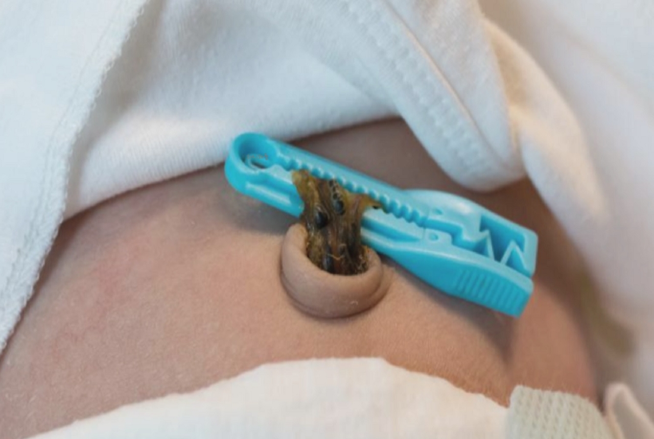 A portion of a baby’s cut umbilical cord is clamped with a plastic clip. (Naver)