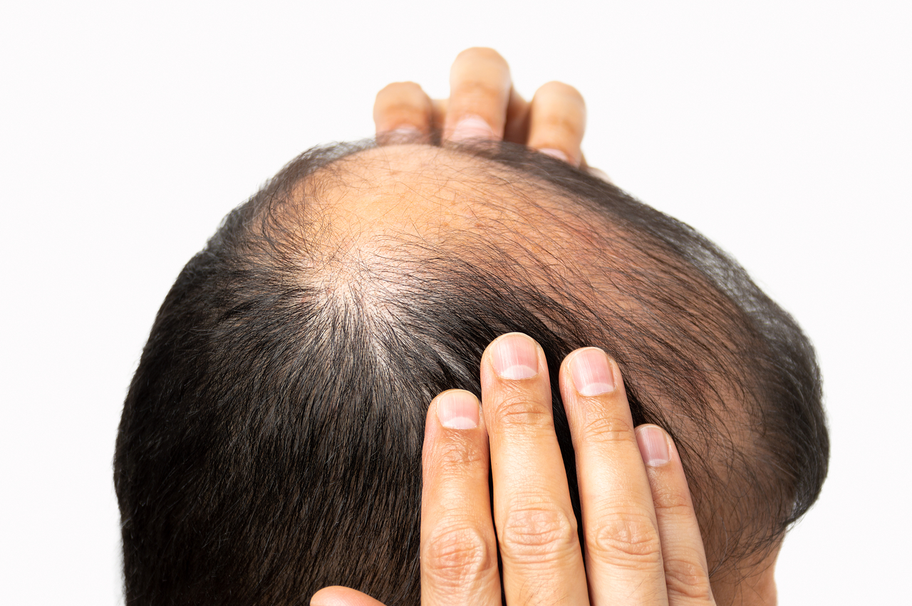 An illustration showing a man with hair loss (Getty Image Bank)