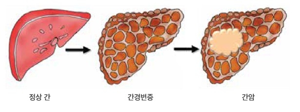 간암 진행 과정(출처:대한간암학회)