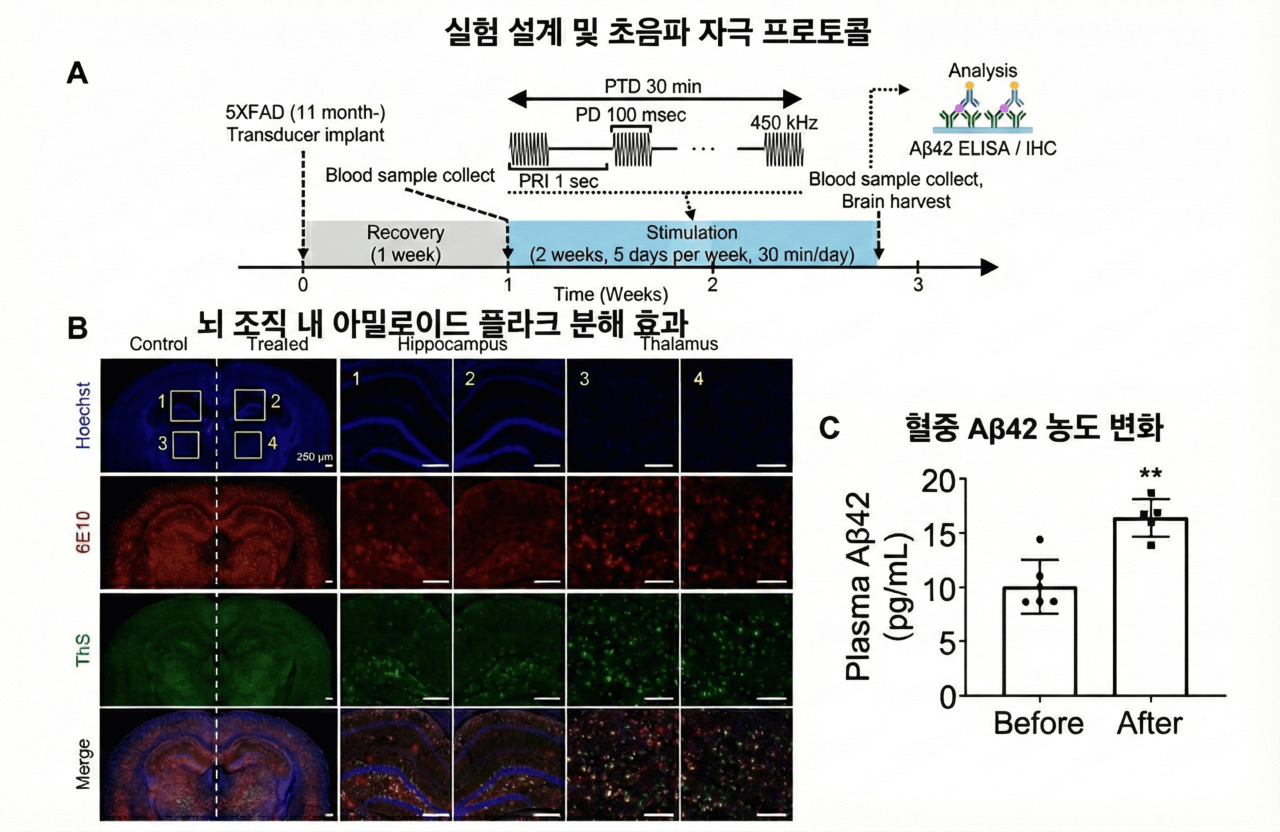 김태열의 생생건강S펜] “국내연구진,약물 없이 초음파로 알츠하이머 원인 물질 65% 제거 확인” - 헤럴드경제