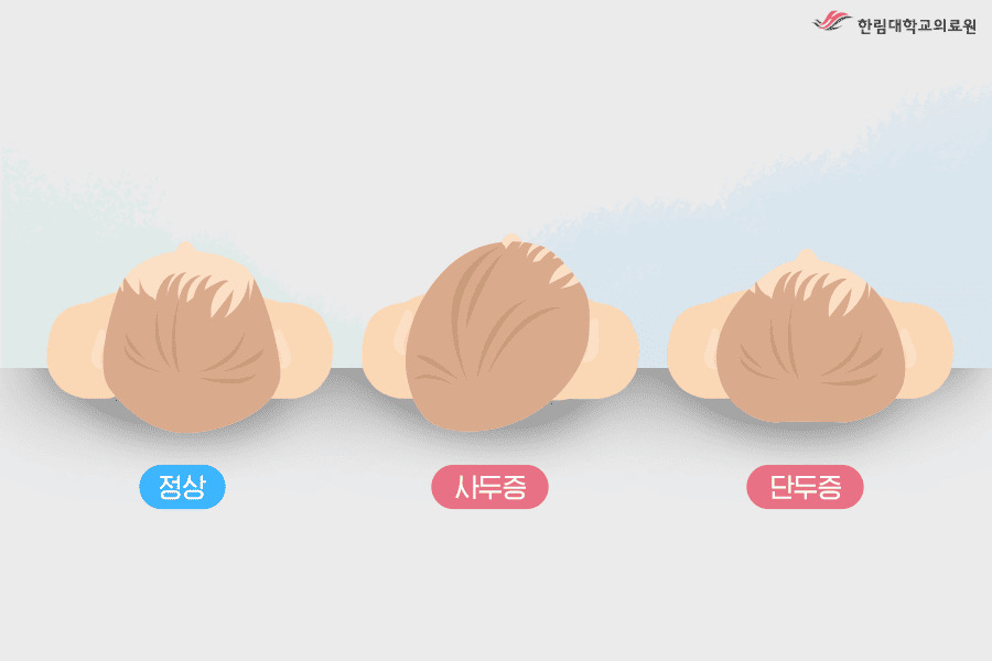 영유아의 두개골 변형 유형
