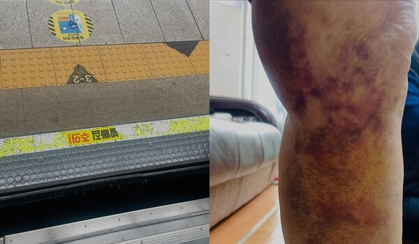 The injured leg of a woman in her 80s (right) who fell into the gap between the train and the platform at Gimpo International Airport Station on Seoul Subway Line No. 5. (Online communities)