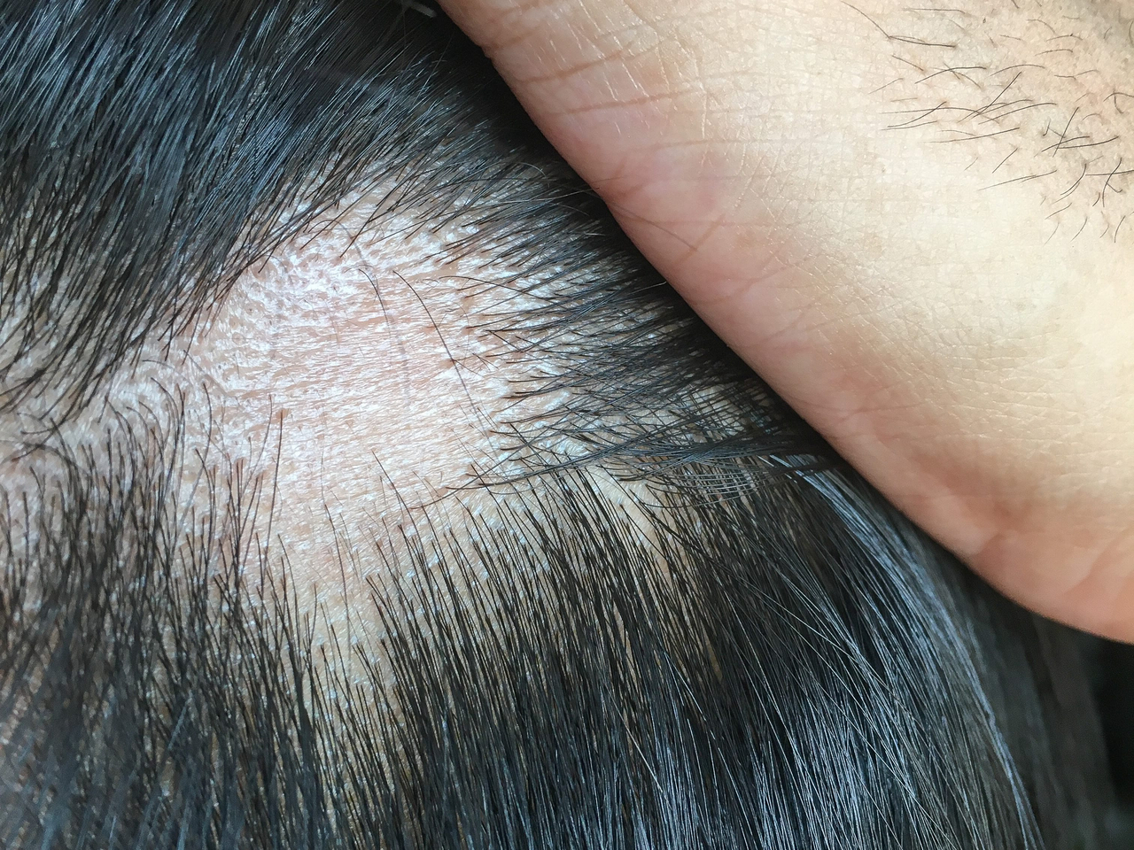 A stock photo shows a man suffering from hair loss. (123rf)