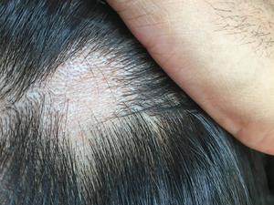 Korea expands insurance coverage for treatment of severe hair loss