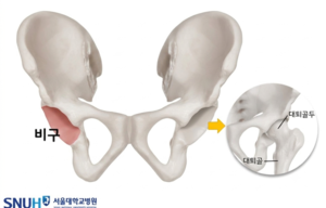 [김태열의 생생건강S펜] “인공고관절 했는데도 괴사하거나 반복적 탈구, 서울대병원 로봇 활용 재치환술로 해결”