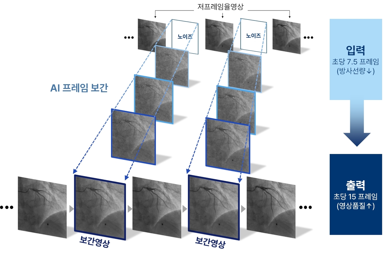 관상동맥조영술 프레임 보간 모델 Angio-FILM 모식도.[분당서울대병원 제공]