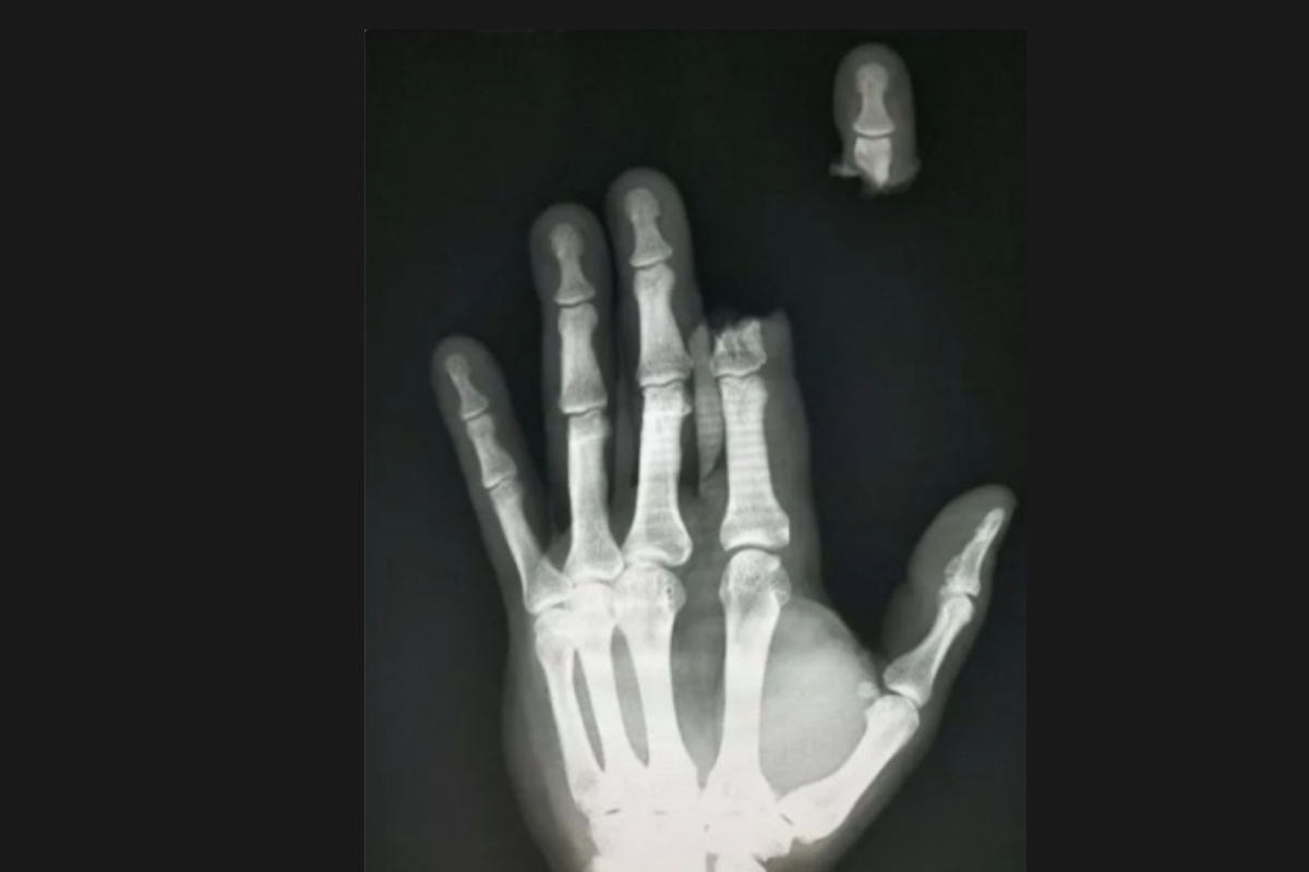 손가락 절단 사고 환자의 엑스레이(X-ray) 사진 [사진, 이호형 교수 SNS 캡처]