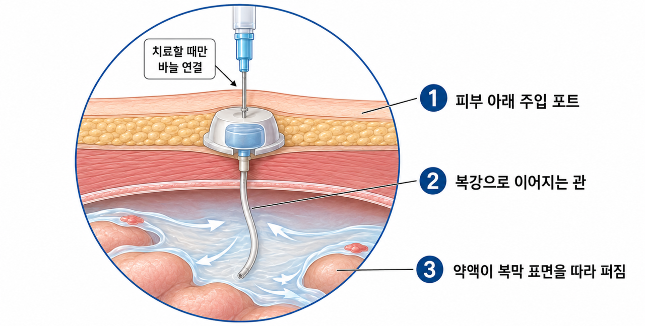 복강 내 파클리탁셀 주입 치료 개념도