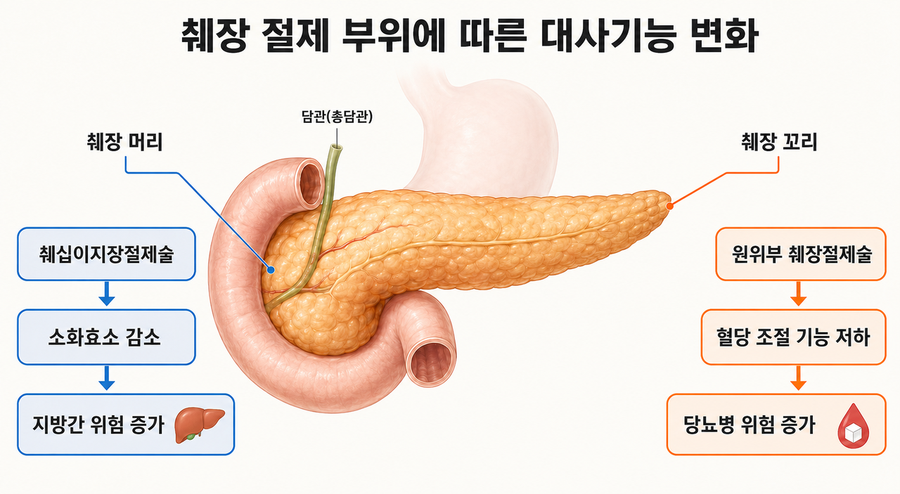 췌장 절제 부위에 따른 대사기능 변화 개념도.[분당서울대병원 제공]