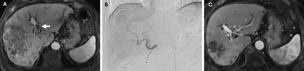 Imaging scans showing the treatment response of a patient with advanced hepatocellular carcinoma following hepatic arterial infusion chemotherapy. [Provided by Seoul St. Mary's Hospital]