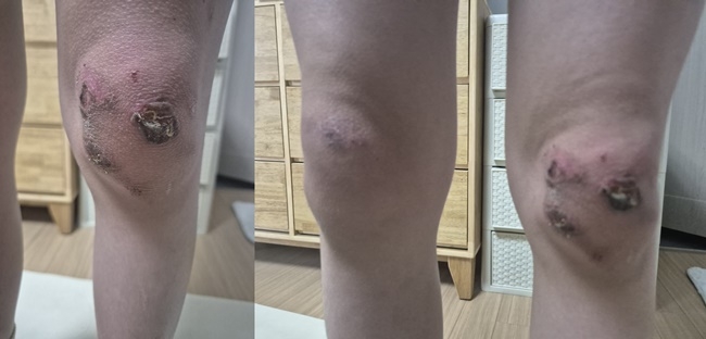 순천 인라인 경기장 트랙을 질주하다 넘어져 찰과상을 입은 선수의 무릎.