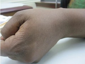 항암 치료받다 피부 ‘감염’까지…서울대병원서 겪은 ‘황당’ 사연, 뭐길래 [메디컬 생존 게임]