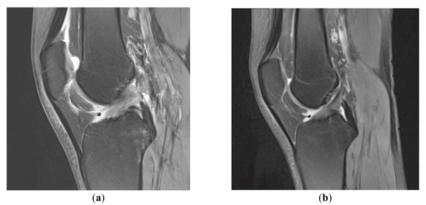 MRI scans show a complete anterior cruciate ligament (ACL) rupture in a 29-year-old male patient before treatment (left) and improved ligament appearance three months after treatment (right). (Miracell)