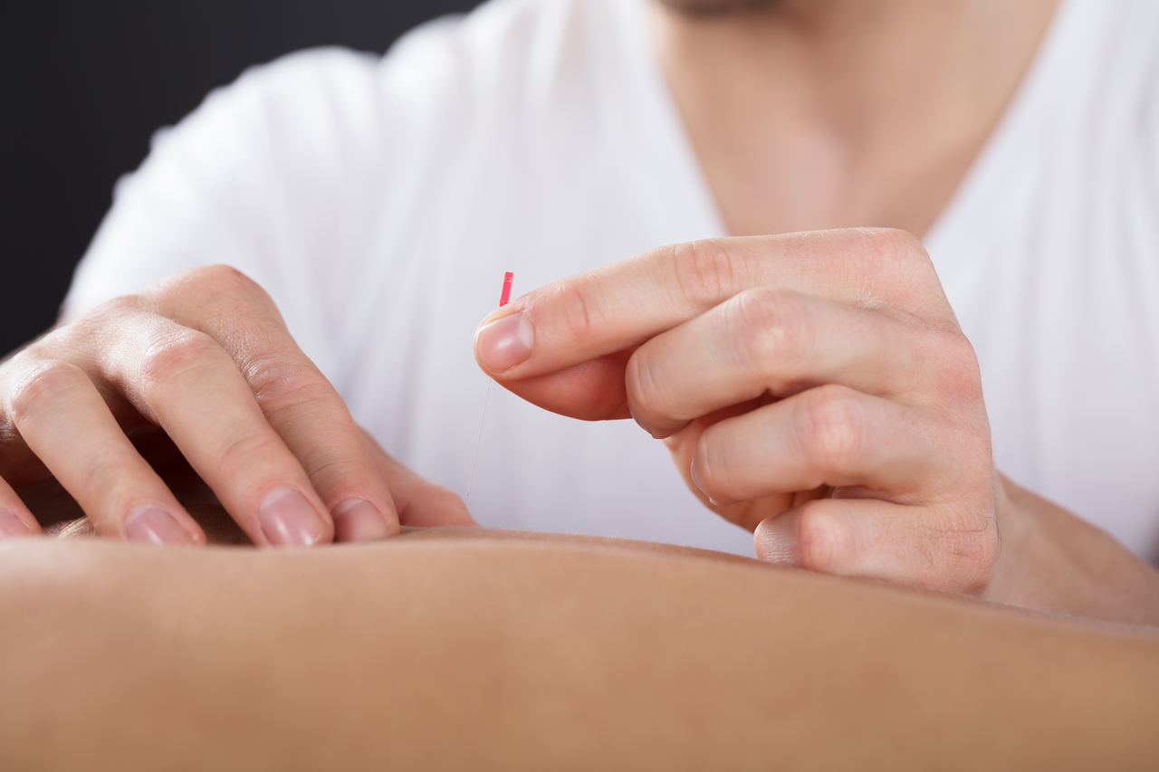 An example image of a person getting acupuncture on the back. (GettyImages)