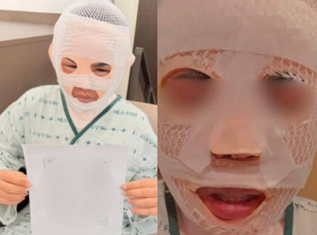 잠자고 있던 태국인 아내의 얼굴에 끓는 물을 부어 화상을 입힌 혐의로 1심에서 징역 3년 6개월을 선고받았던 40대 한국인 남성이 항소심에서 감형을 받았다. 사진은 피해자가 심각한 화상을 입은 모습. [페이스북 캡처]