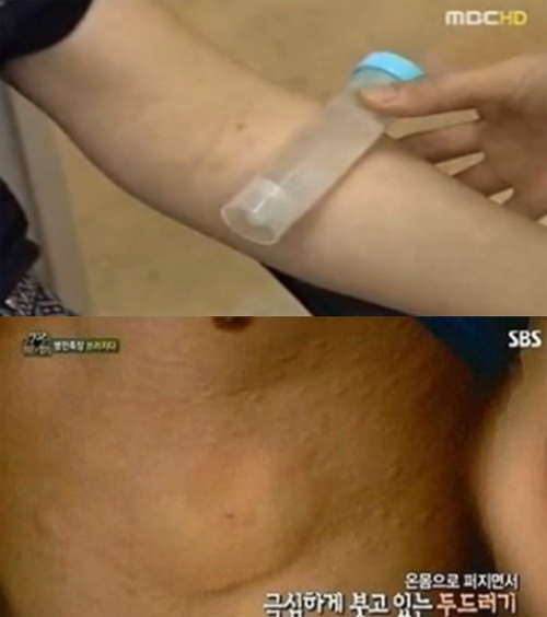 사진 : 한랭두드러기 특징 / MBC , SBS