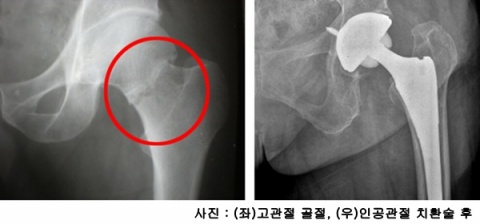 도움말 : 제일정형외과병원 정형외과전문의 조재현 원장