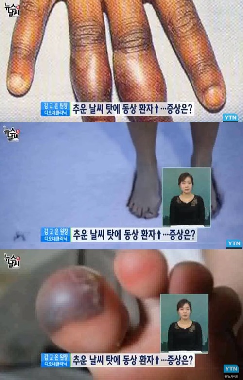 사진: 동상의 증상 / YTN 방송화면 캡쳐